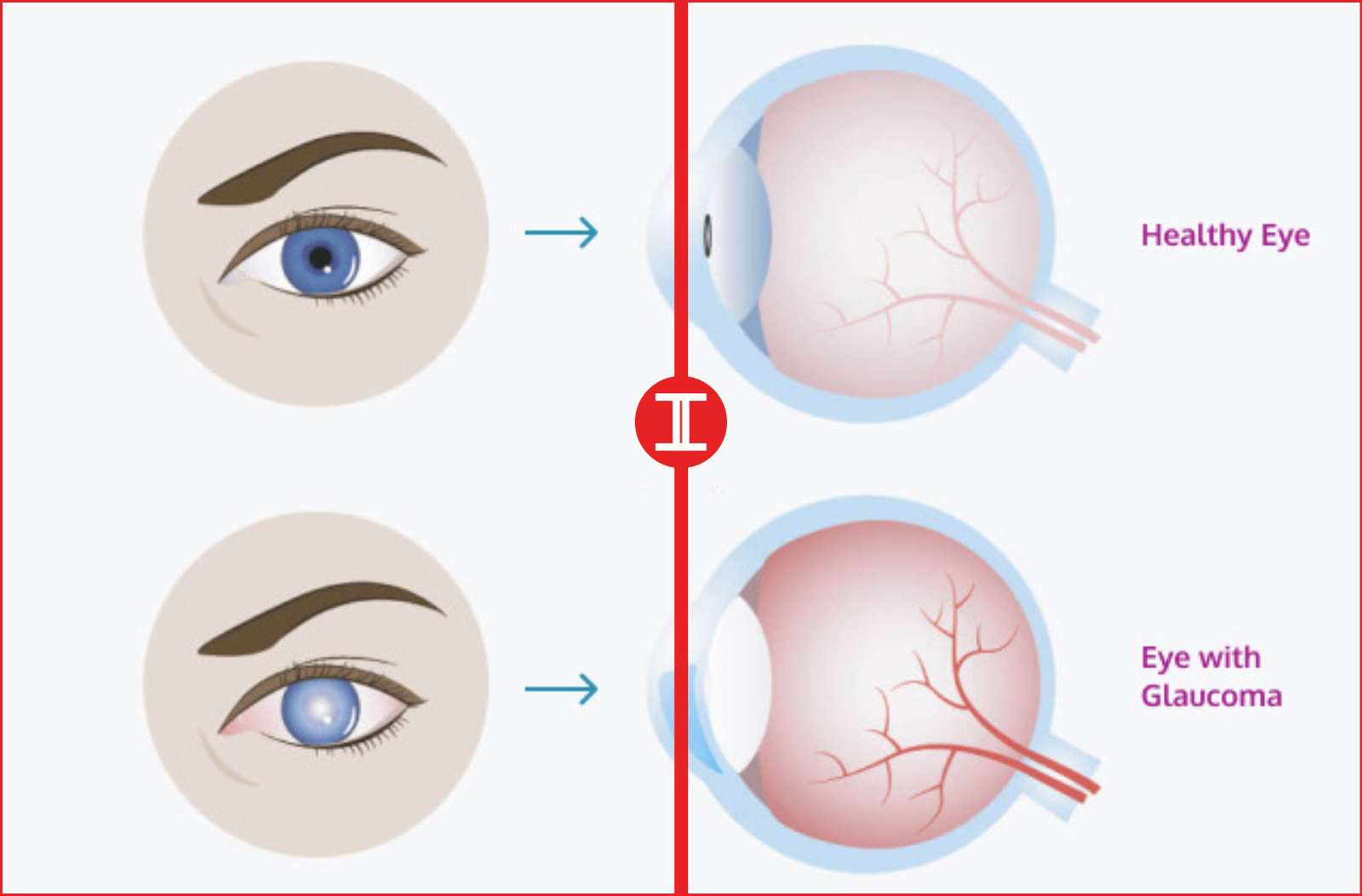 pain behind eye Glaucoma