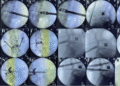 Endoscopic Lumbar Fusion