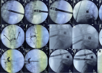 Endoscopic Lumbar Fusion