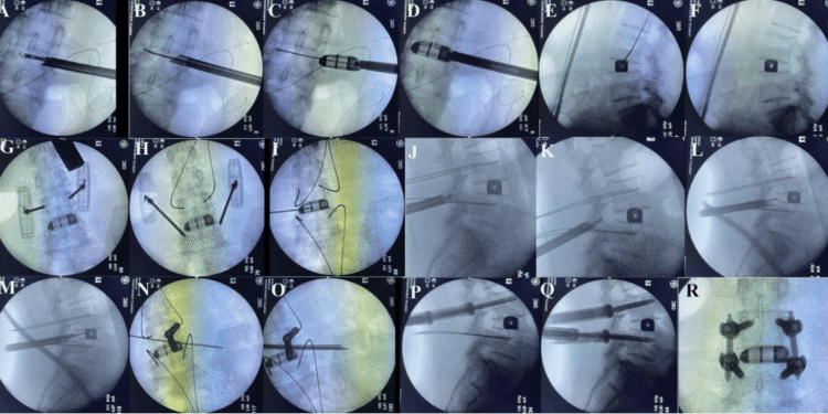 Endoscopic Lumbar Fusion