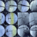 Endoscopic Lumbar Fusion