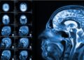 Hidden Brain Injuries