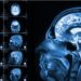 Hidden Brain Injuries