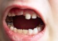Knocked-Out Tooth