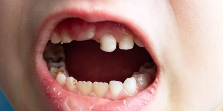 Knocked-Out Tooth