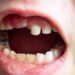 Knocked-Out Tooth