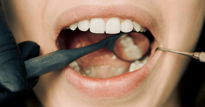 teeth grinding night guard lower hutt