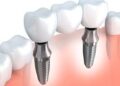 Essential guide to Dental Implants Newcastle for first time patients