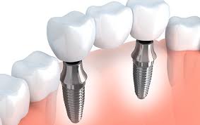 Essential guide to Dental Implants Newcastle for first time patients