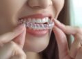Your Complete Guide to Invisalign Middlesbrough Treatments