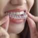 Your Complete Guide to Invisalign Middlesbrough Treatments