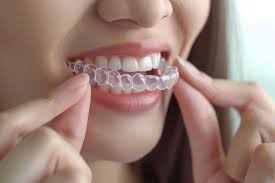 Your Complete Guide to Invisalign Middlesbrough Treatments