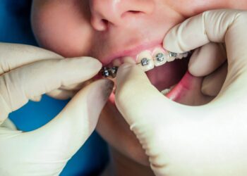 The Benefits of Starting Orthodontic Care Early