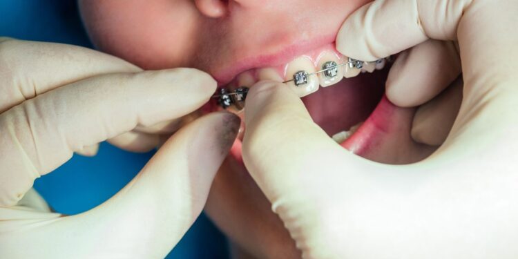 The Benefits of Starting Orthodontic Care Early